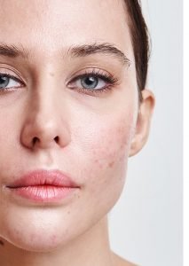 nega problematicne koze